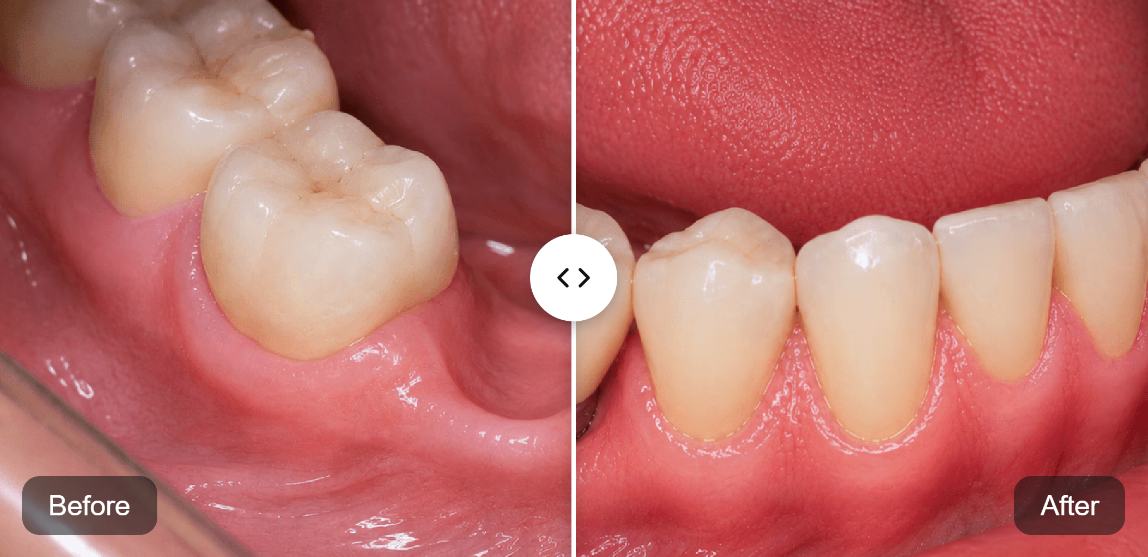 Dental Implants before and after
