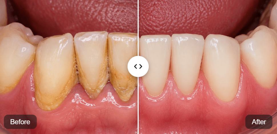 Tartar Removal before and after
