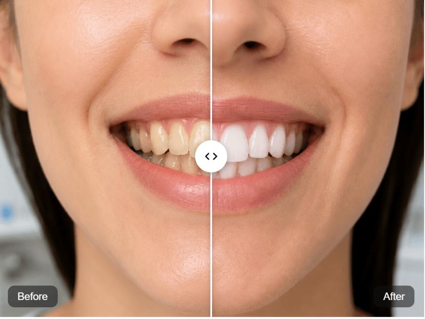 Teeth Whitening before and after